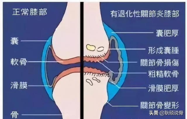 骨性关节炎吃什么药:骨性关节炎平时应该如何预防？