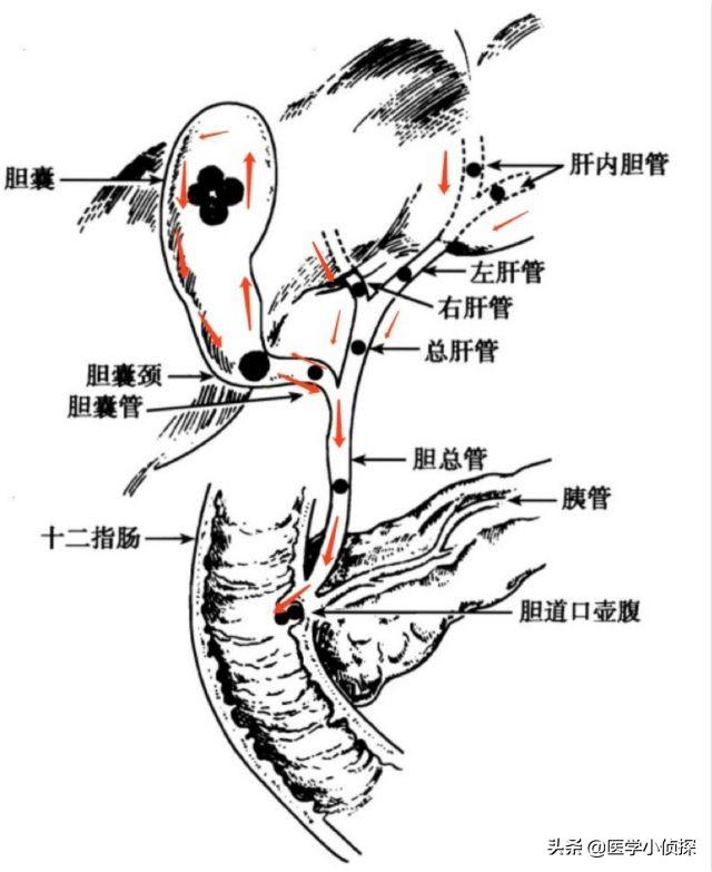 三大抗癌石,胆囊息肉、胆结石会转化为胆囊癌吗？