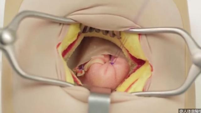 女性阑尾炎手术会尴尬吗?-头条问答