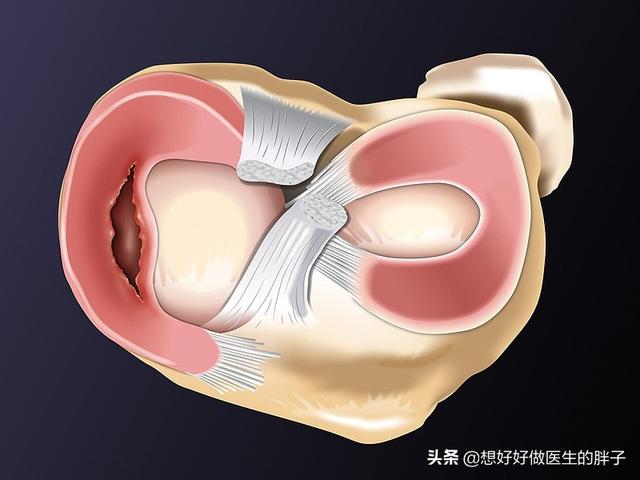 半月板损伤症状:半月板损伤症状有哪些 膝盖半月板损伤还能治好吗？