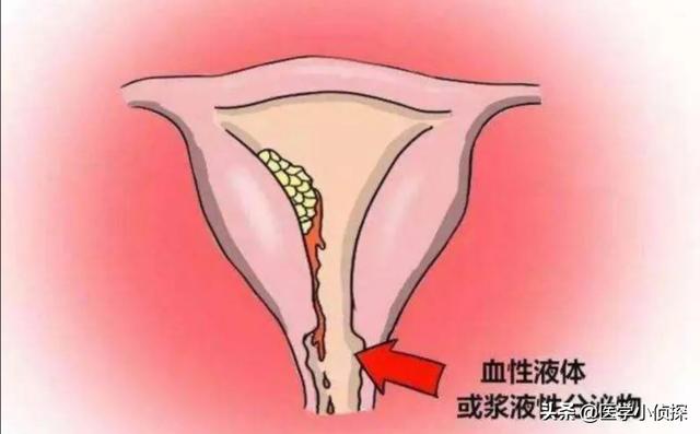7莱姆病症状太容易被忽视:哪些症状连续出现是癌症的表现？