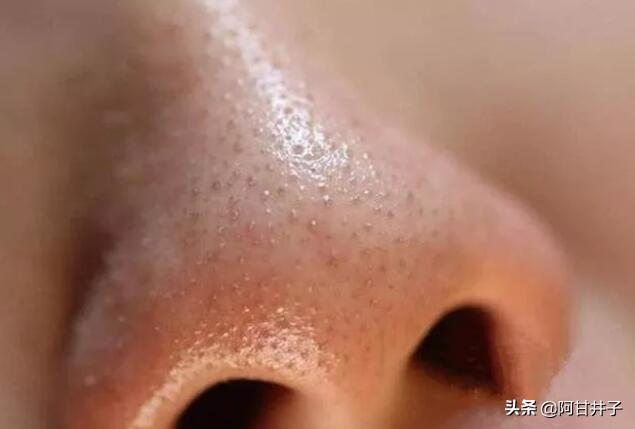 面部螨虫图片:脸上“螨虫”过多，皮肤粗糙暗黄怎么办？