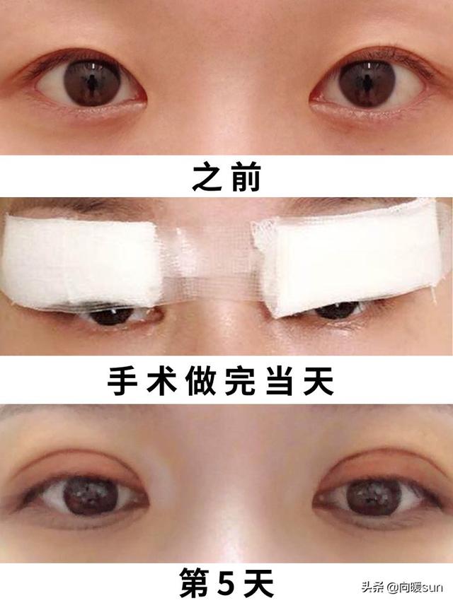 割完双眼皮用氯霉素滴眼液:做完双眼皮手术，如何快速恢复？