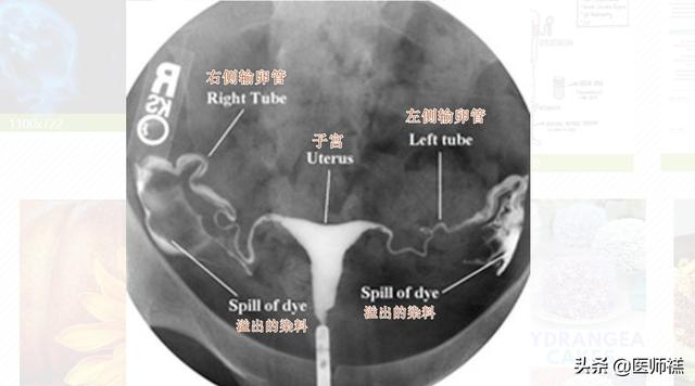 输卵管堵塞怎么治疗好;输卵管堵塞怎么治疗好得最快