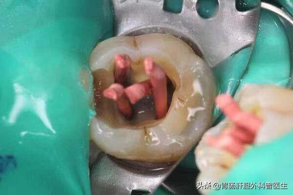 去补牙被医生钻开牙髓根管治疗了一次现在后悔了有没