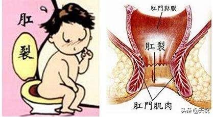 大便后肛门疼是怎么回事?