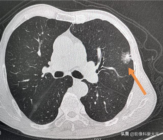 悟空问答 肩疼是肺癌症早期信号吗 养肺注意哪些 长腿医生的回答 0赞