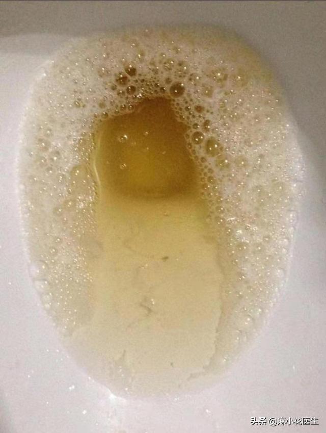 浅谈尿毒症的早期症状:尿毒症早期的蛛丝马迹，哪些容易被我们忽略？