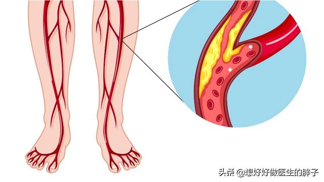 间歇性跛行:间歇性跛行 关节炎会引起间歇性跌行吗？