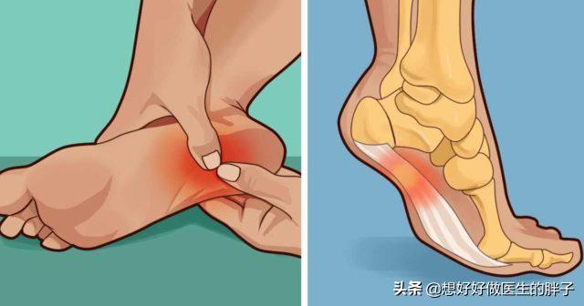 足底筋膜炎有什么征兆，“足底筋膜炎”和“跟骨骨刺”有区别吗