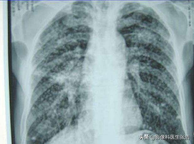 尘肺病是一种职业病吗，尘肺和肺癌哪个更有杀伤力为什么