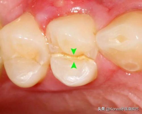 牙齿分为哪几种图一共几个图片:牙齿老是隐隐作痛?到底是犯了什么牙病？