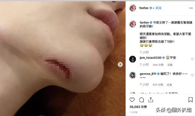任家萱烧伤图片:范玮琪摔伤下巴缝了15针，如何看待明星网上晒受伤的行为