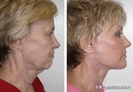 面部提升的最佳方法(面部提升的最佳方法2021年)