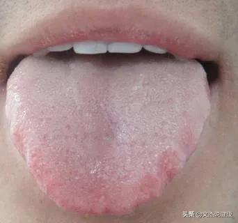 舌头胖大有齿痕，需要怎么调理？插图29