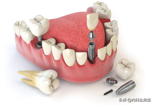 种植牙会不会容易坏，做种植牙对身体有哪些影响