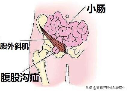 左下腹疼痛是怎么回事 芬芳首席曾医生的回答 头条问答
