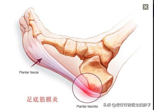 脚底疼痛是什么情况？