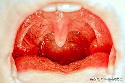 喉咙有点肿怎么回事?