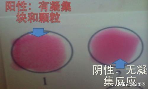 布氏杆菌病症状:布氏杆菌病症状和治疗 奶牛布氏杆菌病如何防治？