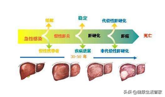 肝硬化的症状有哪些(肝硬化的症状有哪些)