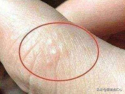 手癣图片:手指关节处皮肤发痒，是怎么回事？