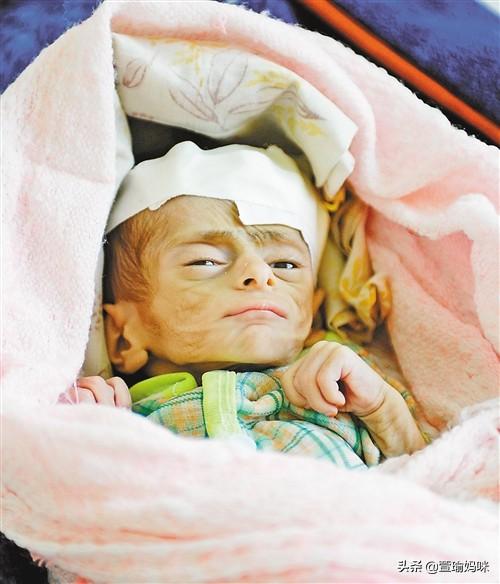 头条问答 - 孩子营养不良,是由哪些原因引起的呢?(32个回答)