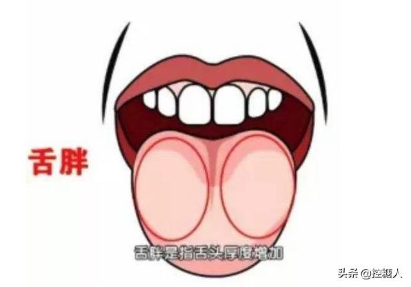 舌头胖大有齿痕，需要怎么调理？插图25
