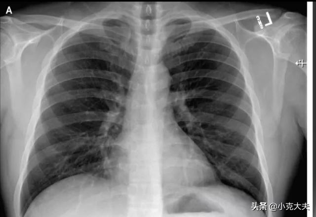 染上新型冠状病毒几天会死:冠状病毒要熬过多少天才算安全？