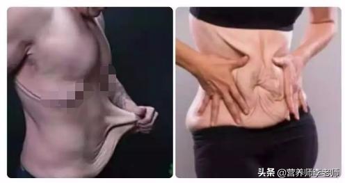 暴瘦后下腹皮肤松弛，该怎么办？