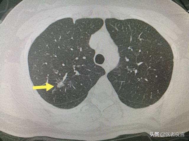 确诊新冠肺炎的诊断标准有哪些，新冠肺炎确诊病例诊断标准是什么