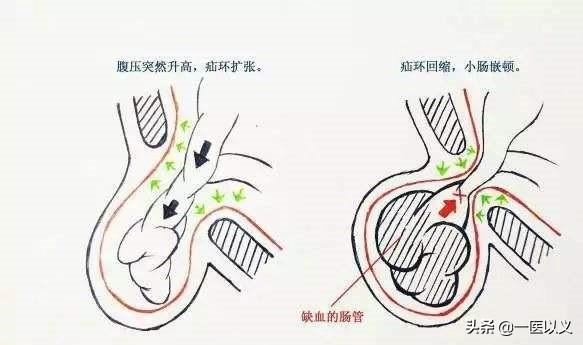 头条问答 - 朋友要做腹股沟斜疝手术,请问术后并发症有哪些?(4个回答)