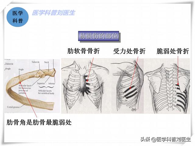 肋骨骨裂的症状:第五、六根肋骨骨折了，需要如何休养才能好的比较快？