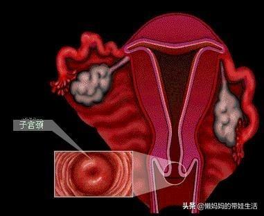头条问答 - 宫颈细小影响自然分娩吗?(8个回答)