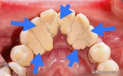 牙结石症状:牙结石症状是什么 牙结石是如何形成的？洗了牙之后要怎么做才能防止再长牙结石？