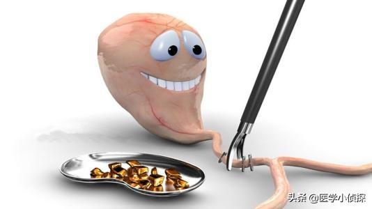 三大抗癌石,胆囊息肉、胆结石会转化为胆囊癌吗？