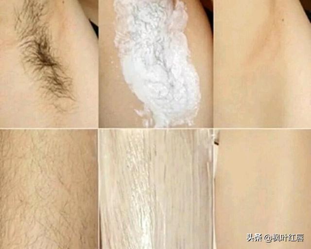 给b脱毛:非医美，哪种脱毛方法最好啊？