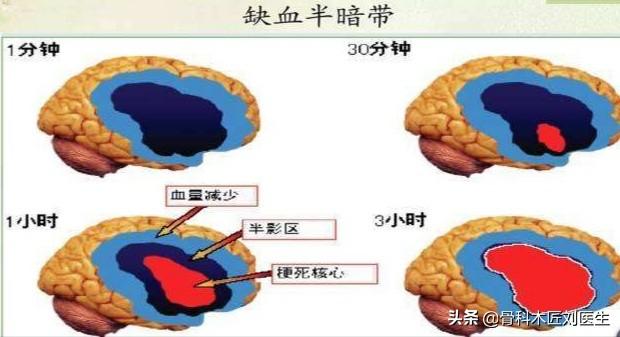 60多岁男子,脑梗离世,医生坦言：糖尿病者,3个信号不能忽视！说的是哪3个信号？