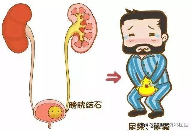 老人尿结石治疗方法:尿结石有什么症状？如何应对？