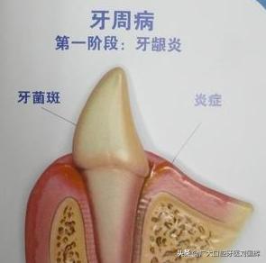 洗牙之前要做哪些检查:有必要定期做口腔检查以及洗牙吗？