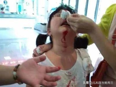 小孩鼻子出血怎么回事，儿童鼻子出血是什么原因