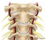 颈神经根炎的症状与治疗:颈椎椎间盘突出C3C4C5压迫神经根及硬膜囊是什么症状？