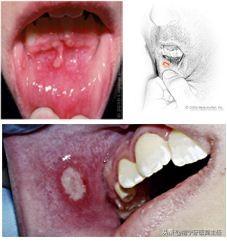 最明显的特征是张口受限,嘴巴张不大引起牙痛的常见原因有以下几个:痛