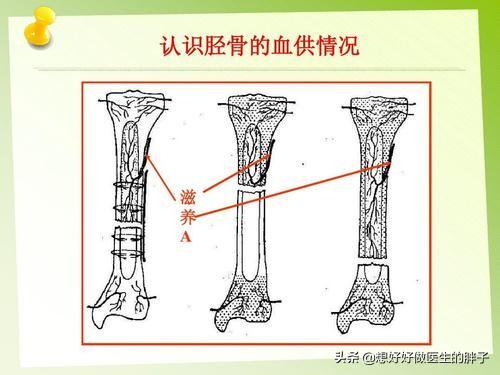 胫腓骨骨折保守治疗一个月:右胫腓骨骨折多少天能下地负重行走？