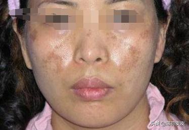 如何对脸上多年斑点说拜拜，脸上的斑点怎么去除或淡化呢