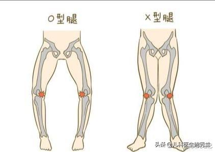 髋关节脱位:父母如何及早发现宝宝髋关节是否有脱位现象？