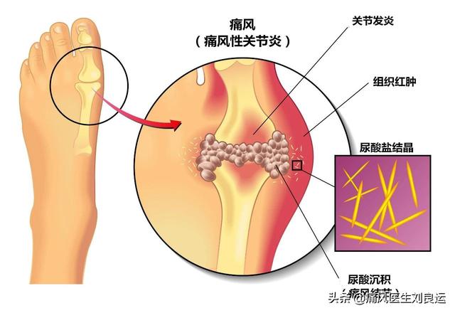 黄精蝮蛇丸:什么食物能溶解尿酸结晶？