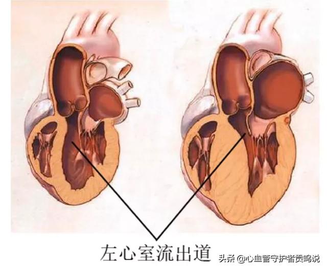 肥厚型心肌病心超分型:肥厚型心肌病，该如何控制血压？