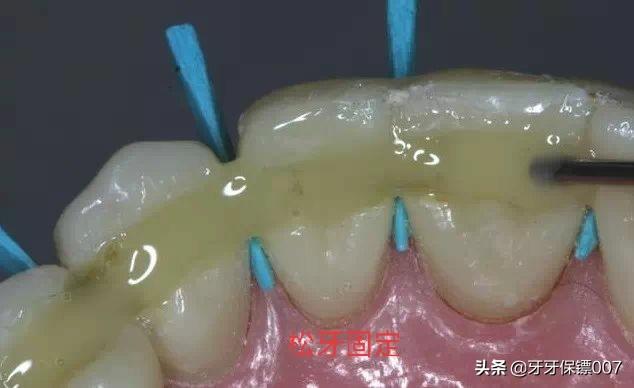 牙弓夹板牵引带久了牙齿酸:矫正牙齿后牙齿会不会变得脆弱？