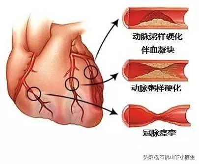 冠心脏病的症状有哪些:冠心病和其他心脏病的症状有什么不同？